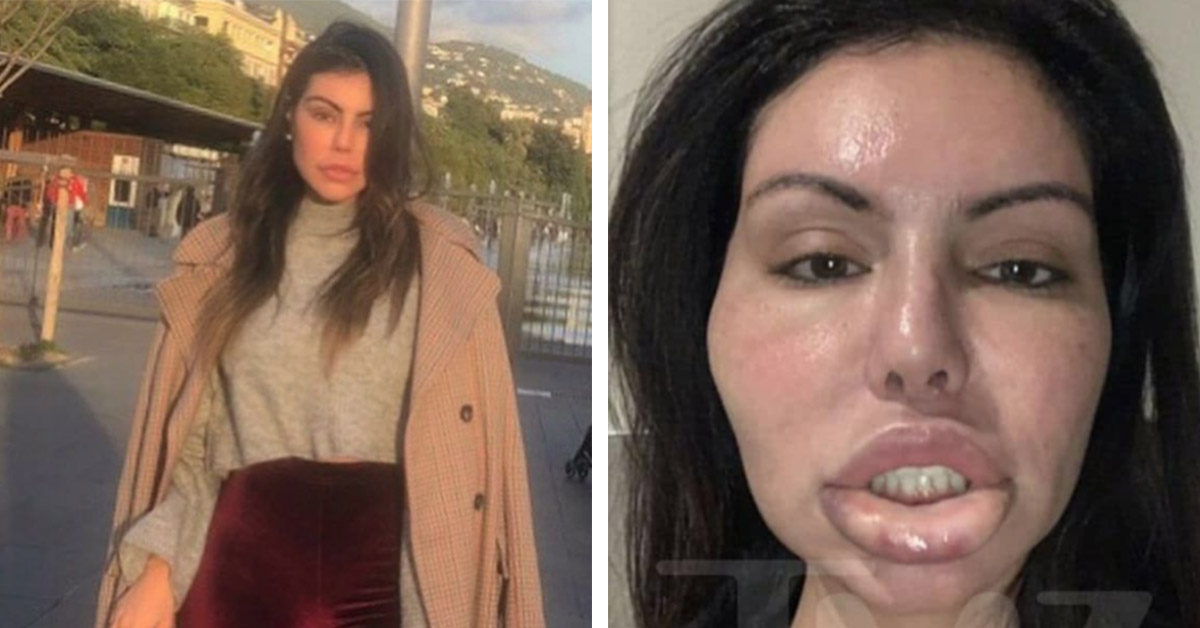 Supermodel Feels Like Her Face Is “Gonna Explode” From Badly Botched Botox