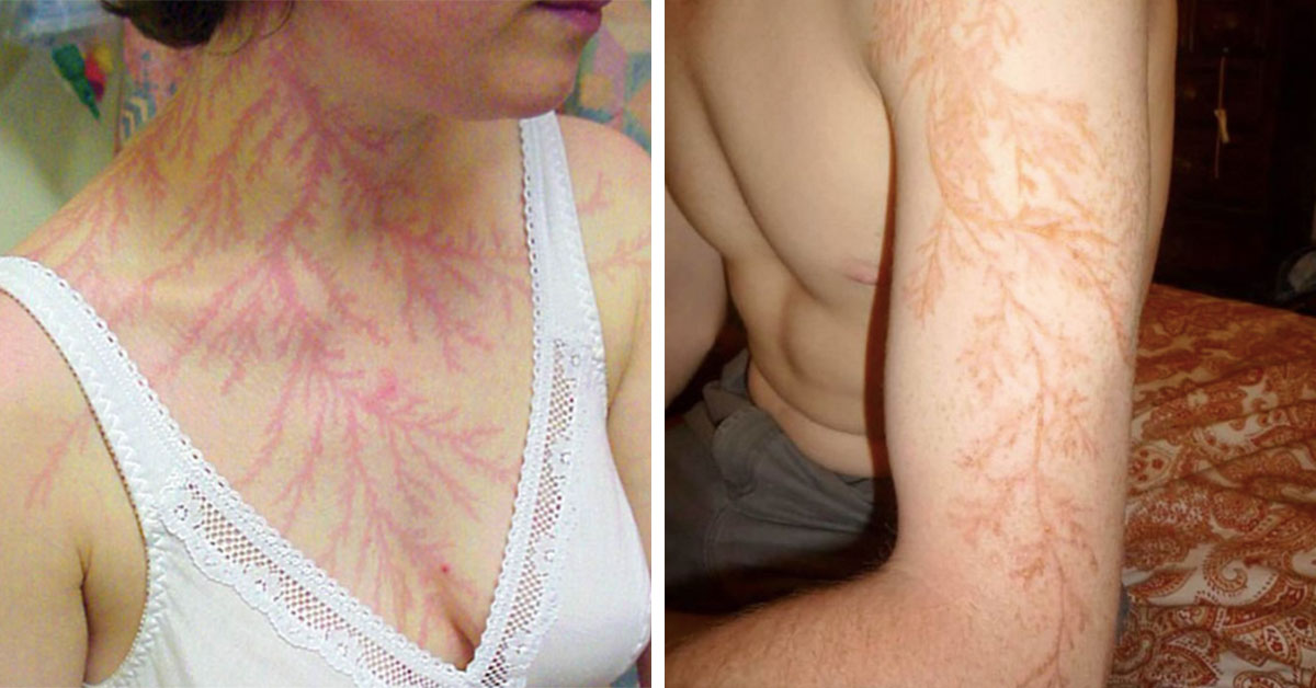 These 19 People Were Struck By Lightning And What Happened To Their Skin Is Incredible