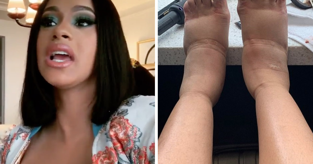 Cardi B Cancels Gigs, Revealing Insanely Swollen Feet Post Lipo Suction